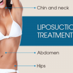 liposuction