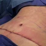 abdominoplasty_completely_sutured