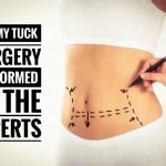 Abdominoplasty