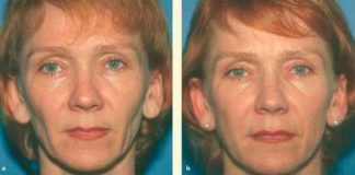 Face Fat Transferring: Things you ought to know about